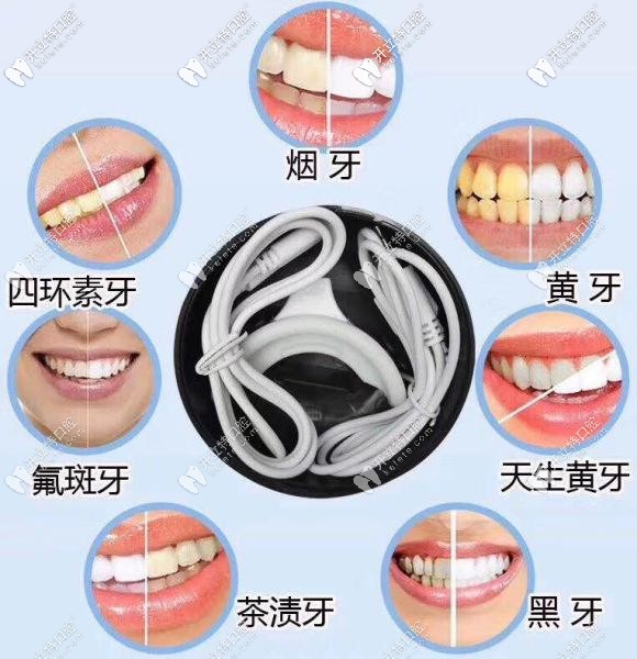 牙齒有這些情況都可以通過美白來改善