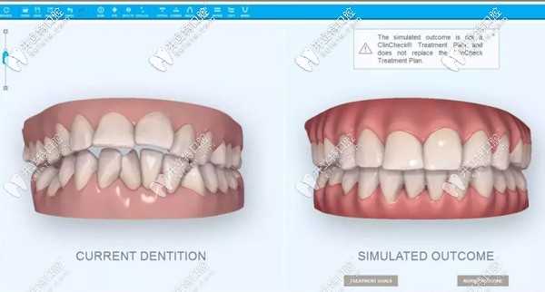 隱適美iTero口掃儀呈現(xiàn)的矯正效果圖 隱適美iTero口掃儀呈現(xiàn)的矯正效果圖