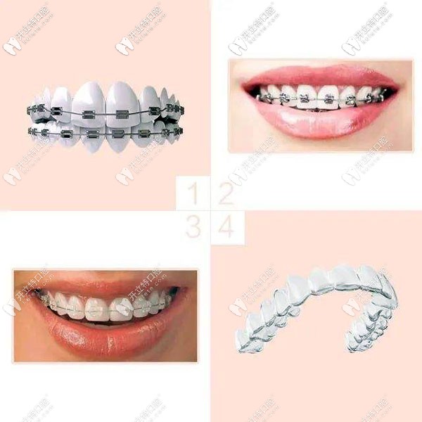各種牙齒矯正器