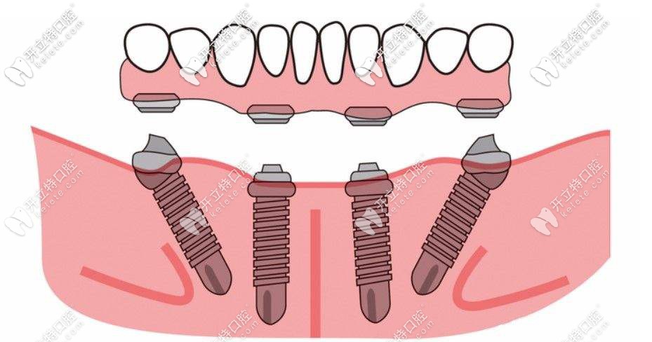 all-on-4半口種植