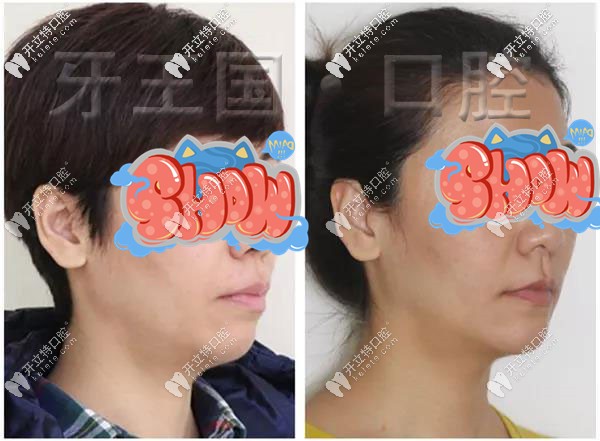 我牙齒骨性前突在蘭州西固區(qū)做完舌側(cè)隱形矯正后真的很nice 