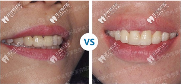 貴陽華美口腔牙齒矯正案例