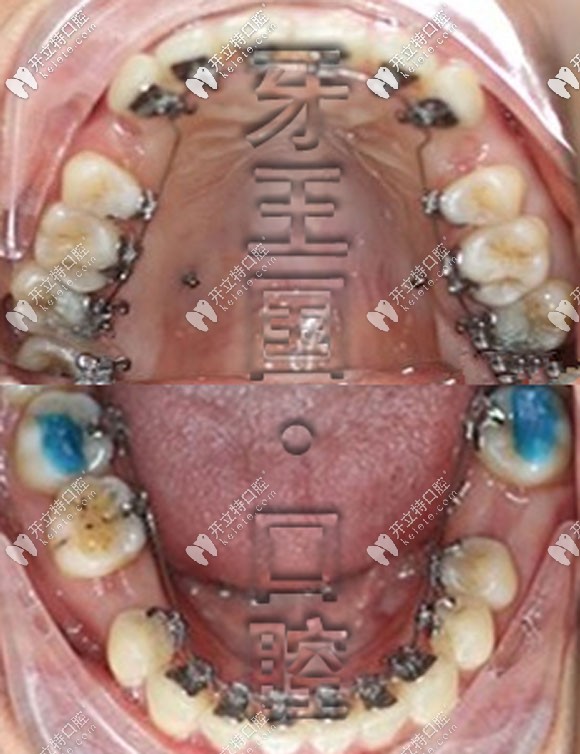 牙王國口腔舌側(cè)矯正