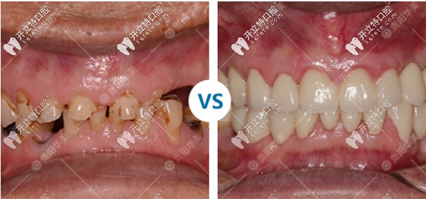 貴陽華美口腔種植牙案例