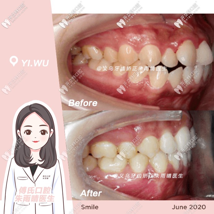 傅氏口腔矯正案例前后對(duì)比
