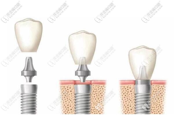 進(jìn)口種植牙系統(tǒng)