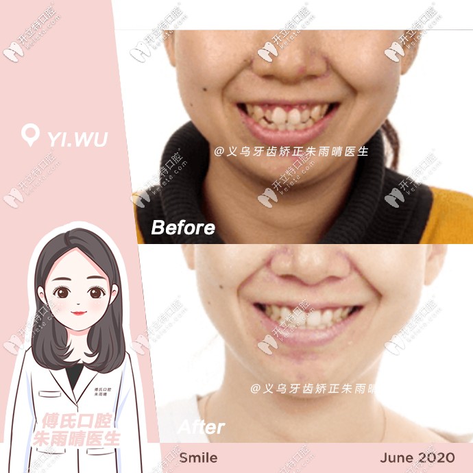 矯正前后正面對(duì)比