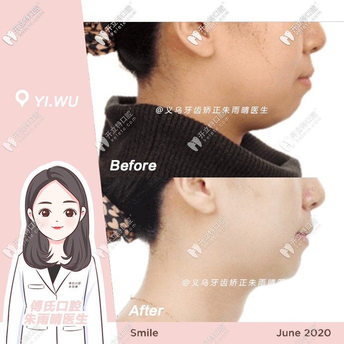 骨性二類矯正前后對(duì)比側(cè)面照