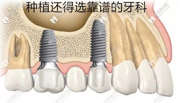 西安種植牙口腔醫(yī)院排名:西安美奧/諾貝爾/中諾牙科在榜上