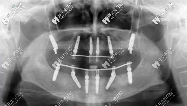 All-on-6全口種植牙