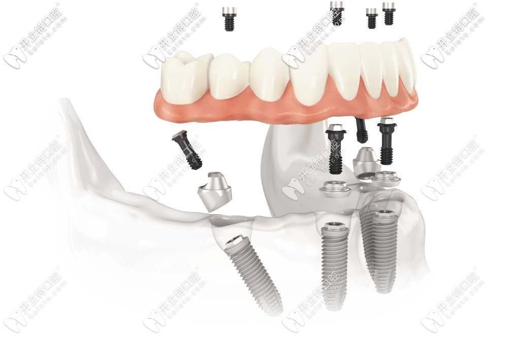 allon4全口種植牙