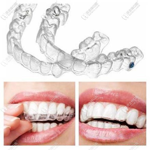 成人隱形矯正圖