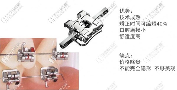 固定鋼絲牙套的特點