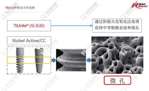 瑞典諾貝爾種植體