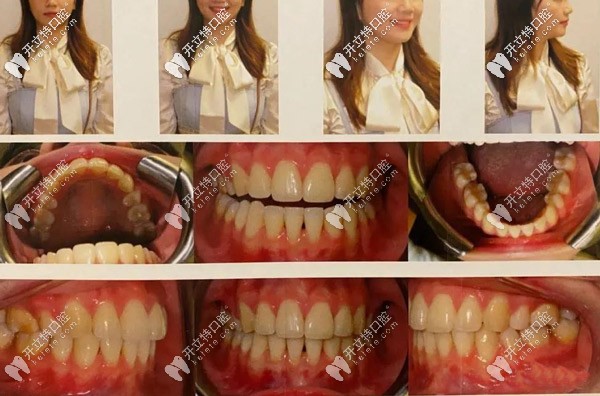 整牙的時間不長，但是<span style=