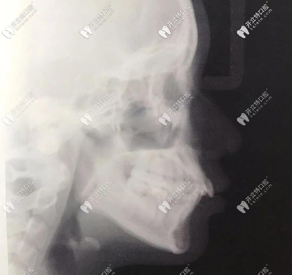 側面X光，門牙唇傾很厲害的