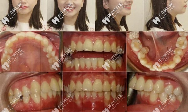 正面、側面照，記錄牙齒的變化情況