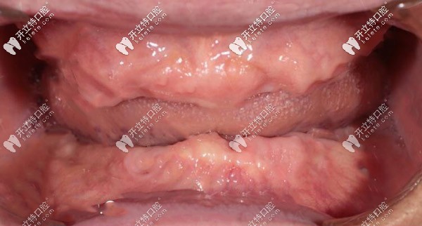 全口無牙頜種植前