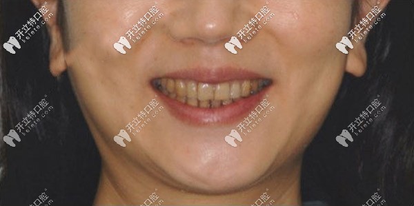 做牙齒貼面前 做牙齒貼面前