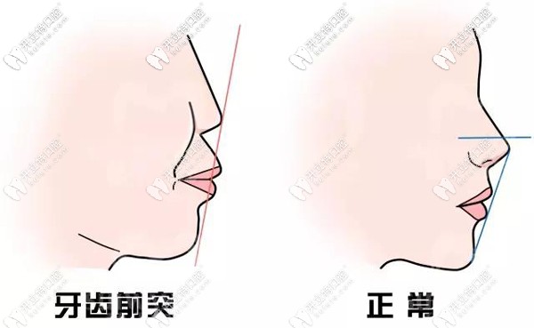 通過(guò)整牙可以改變嘴凸