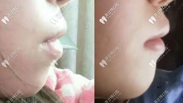 戴牙套可以治療嘴突?且看小姐姐通過(guò)整牙改變凸嘴的效果