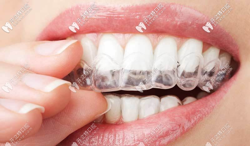 天水市全隱形矯正