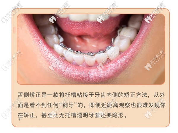 廣州舌側(cè)矯正哪個醫(yī)院好?廣州舌側(cè)成熟醫(yī)院醫(yī)生及價格推薦