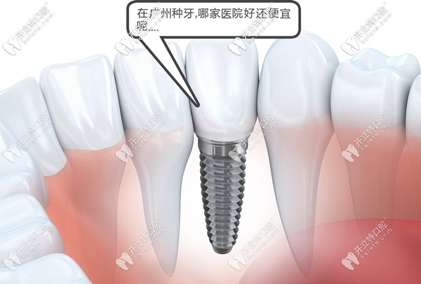在廣州市種一顆牙齒大概多少錢