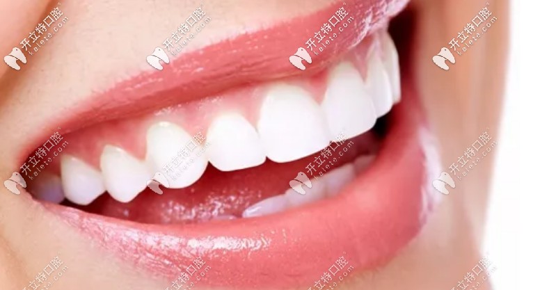 什么是牙齒貼面 什么是牙齒貼面