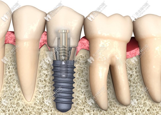 廣州廣州穗華口腔的種植牙價格