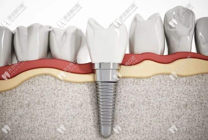 種植牙技術(shù) 種植牙技術(shù)