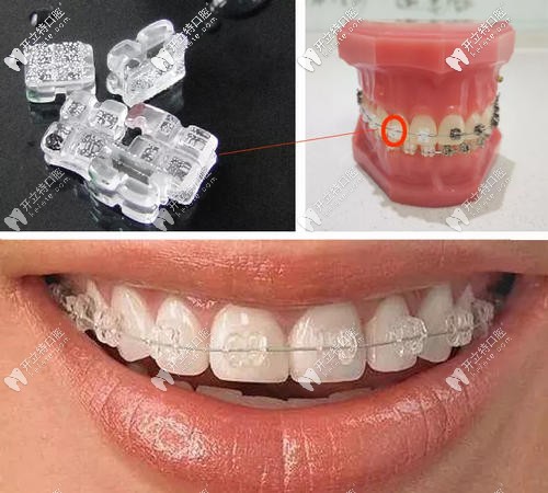陶瓷半隱形矯正 陶瓷半隱形矯正