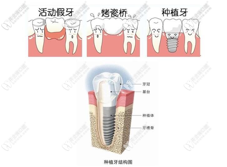 種植牙的結構 種植牙的結構
