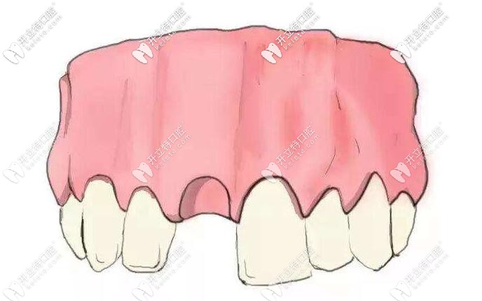 牙列缺失 牙列缺失