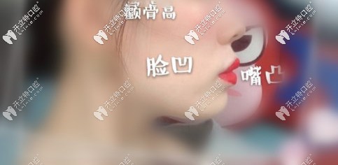 顴骨高、面部凹陷、凸嘴