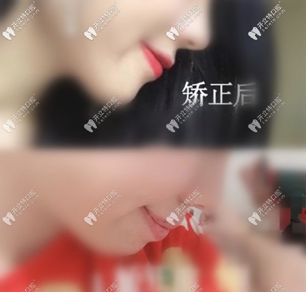 大眾口腔半隱形矯正完成