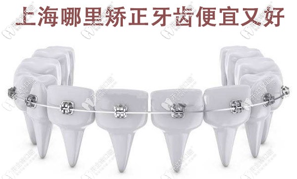 上海哪里矯正牙齒便宜又好，這些有名的牙科醫(yī)院值得選擇