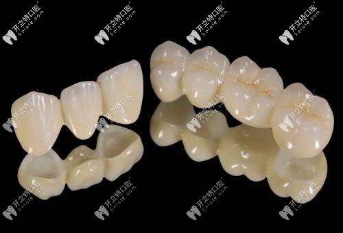 全瓷牙冠外觀 全瓷牙冠外觀