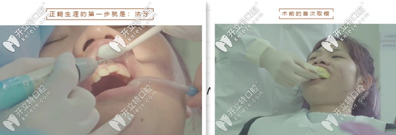 做牙齒矯正檢查項(xiàng)目