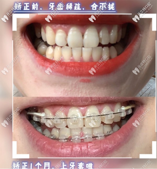對(duì)比看看和我矯正前的牙齒情況