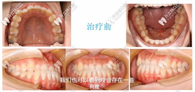 我的地包天牙齒圖