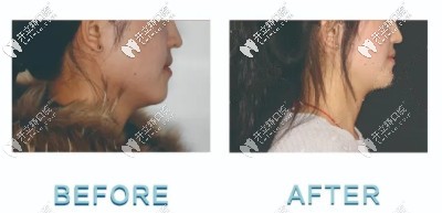 北京禾禾口腔地包天牙齒矯正案例!90后老阿姨為美不擇手段