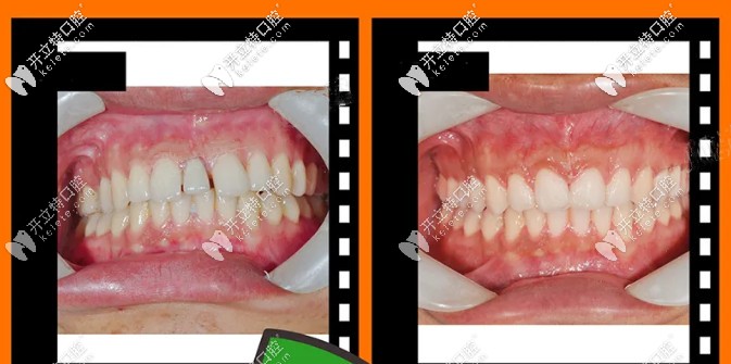 小哥哥的齙牙矯正對(duì)比圖