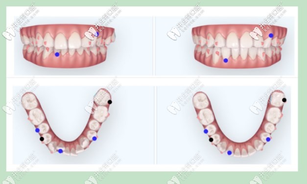 隱形矯正的模擬效果