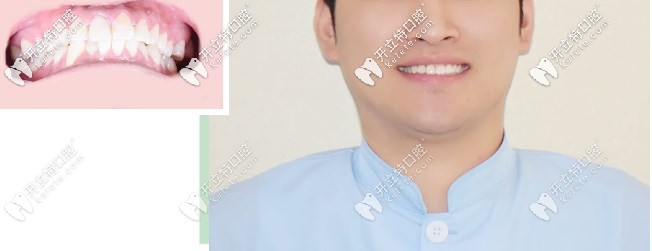 正畸醫(yī)生牙齒前凸戴隱適美隱形矯正，告訴你你不知道的事