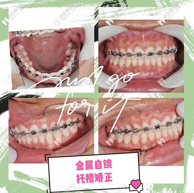 齙牙小哥哥正在佩戴鋼牙套