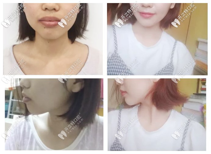 矯正前后的正面、側面對比