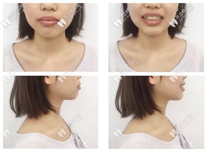 齙牙姑娘在上海永華做時代天使隱形矯正的硬核逆襲之路