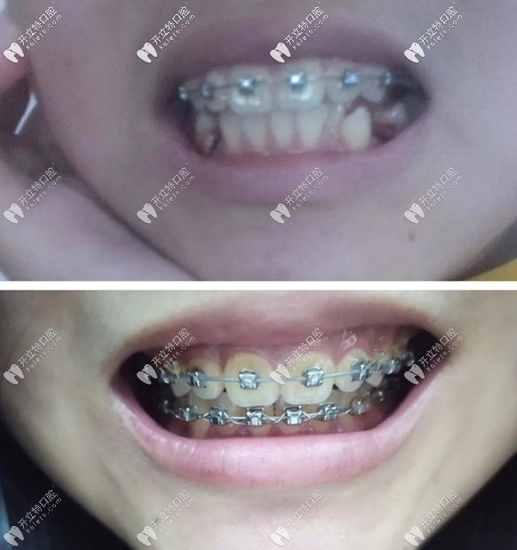 輕微齙牙矯正案例：16歲戴自鎖鋼絲牙套花了1萬五