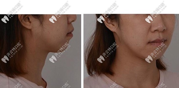 開頜案例側(cè)面照